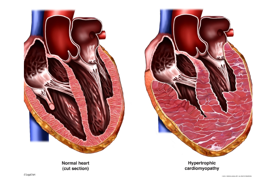 <p>Excess GH/IGF-I can lead to cardiomyopathy, which is a disease of the heart muscle.</p>