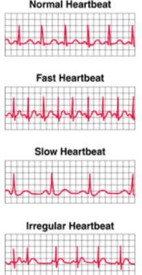 <p>Electrical Conduction Problems</p><p></p><p><strong><span class="tt-bg-yellow">Irregular or abnormal heartbeat</span></strong></p><p>-The SA node doesn't produce the right number of signals</p><p>-Another part of the heart takes over as the <strong><span class="tt-bg-blue">natural pacemaker</span></strong></p><p>-The electrical pathways are <strong><span class="tt-bg-blue">interrupted</span></strong>.</p>