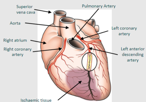 <p>Occlusion in this artery leads to obstruction of blood flow to the anterior (front) left ventricle, resulting in myocardial infarction</p>