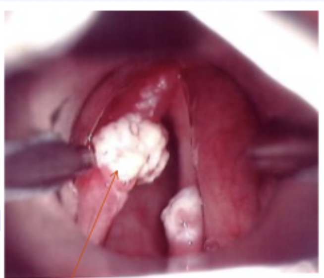 <p>• Lesions that invade the tissue and destroy the normally behaving cells.• Depending on location and size of lesion it may affect vocal fold closure.• If untreated may be life-threatening• Invasion of the tumor into various levels of the lamina propria and muscle results in greater stiffness of the vocal fold tissue.◦ May also restrict or inhibit mucosal wave movement</p><p>Etiology:May be caused by smoking (50-70% of oral and laryngeal cancer deaths are associated with smoking), environmental irritants, chemicals, metabolic disturbances, and unknown causes.</p>