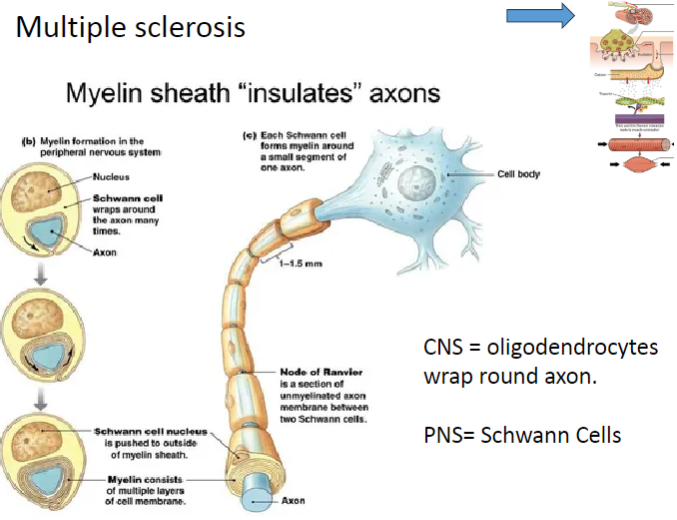 <p>In the <strong>CNS</strong>, <strong>oligodendrocytes</strong> produce myelin and wrap it around the axons of neurons.</p><p>In the <strong>PNS</strong>, <strong>Schwann cells</strong> are responsible for myelin production around axons.</p><p>In <strong>Multiple Sclerosis (MS)</strong>, <strong>demyelination</strong> occurs when the immune system attacks the <strong>oligodendrocytes</strong> in the CNS, impairing nerve function.</p><p><strong>Schwann cells</strong> are not typically affected by MS as much as oligodendrocytes, but their role in myelin repair in the PNS is crucial in other demyelinating conditions.</p>