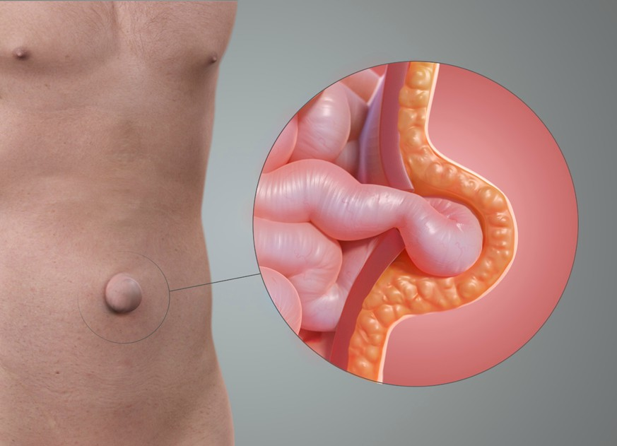 <p>In an umbilical hernia, the intestines return normally to the abdominal cavity, but the rectus abdominis muscle fails to fuse around the umbilicus, leading to protrusion of the gut covered in skin.</p>