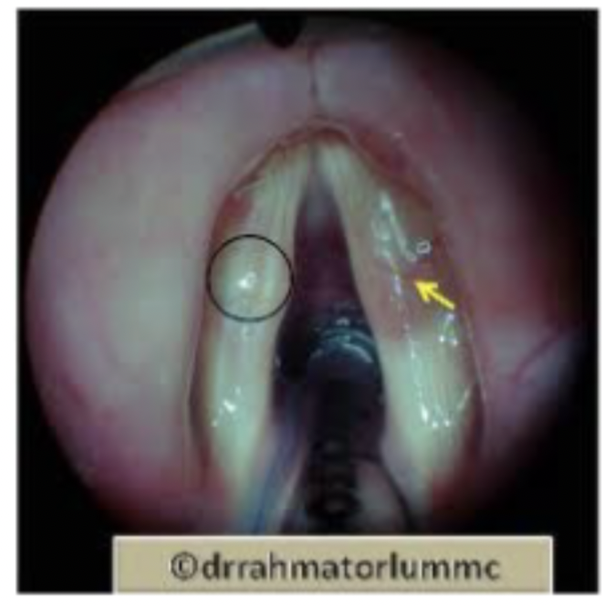 <p>Cysts Characteristics:◦Perceptual: hoarseness, lowered pitch. Patient may report a “tired” voice.◦Acoustic: changes noted for females in reduced phonation range. No other changes reported</p>