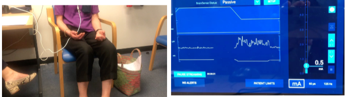 <p>Suppressing beta power improves bradykinesia in Parkinson's disease by reducing the pathological oscillations associated with motor dysfunction, leading to better movement control.</p><p>Recordings from new-generation DBS pacemakers show that reducing beta power can result in significant improvements in motor symptoms, including bradykinesia.</p><p>However, direct stimulation of the subthalamic nucleus (STN) at beta band frequencies can worsen parkinsonism, suggesting that the timing and frequency of stimulation are critical for therapeutic outcomes.</p>