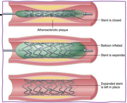 <p>The placement of a stent to dilate and open a blocked vessel.</p>