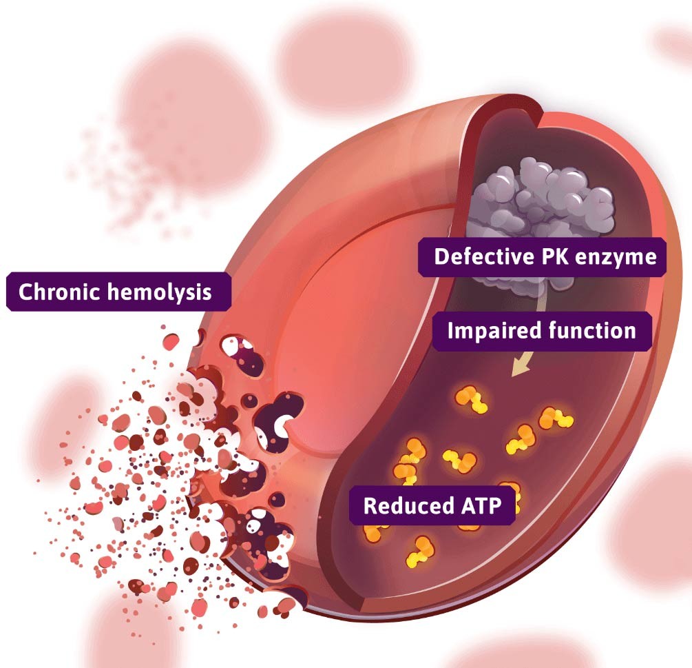 <p>-ATP is depleted</p><p>-Cells lose large amount of potassium &amp; water, becoming dehydrated &amp; rigid.</p><p>-Causes chronic non-spherocytic haemolytic anaemia</p>