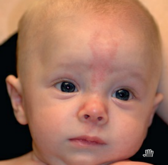 Flat, irregularly shaped red or pink patch found on forehead, eyelid, or upper lip but most commonly on back of neck (nuchal area). Present at birth and usually fades the first year

