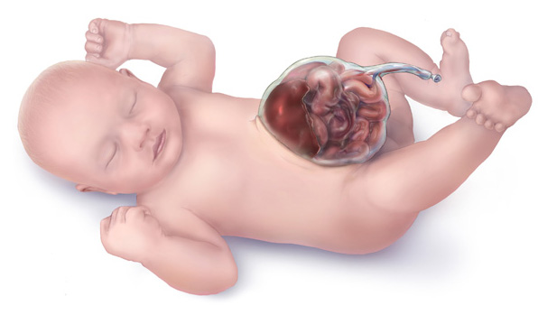 <p>Omphalocele is a condition characterized by the failure of intestinal loops to return into the abdomen, resulting in a hernia covered in amnion.</p>