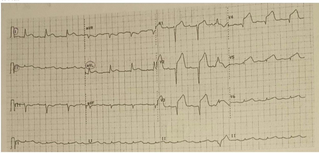 <p>8. Bệnh nhân nam 59 tuổi vào viện vì triệu chứng đau ngực dữ dội kéo dài hơn 20 phút, điện tâm đồ ghi tại khoa cấp cứu như hình dưới. Tổn thương mạch vành của BN trên có thể nghĩ tới là: </p><p>A. Động mạch liên thất trước </p><p>C. Động mạch mũ </p><p>B. Động mạch vành phải </p><p>D. Chưa đủ để kết luận</p>