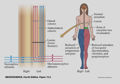 <p><strong>DCML and STT cross the midline at different sites</strong>, affecting the loss of sensory modalities.</p>