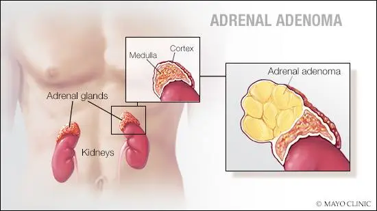 <p><u>Conn's syndrome is often due to:</u></p><p>❀ Adenoma (tumour) of the adrenal cortex.</p>