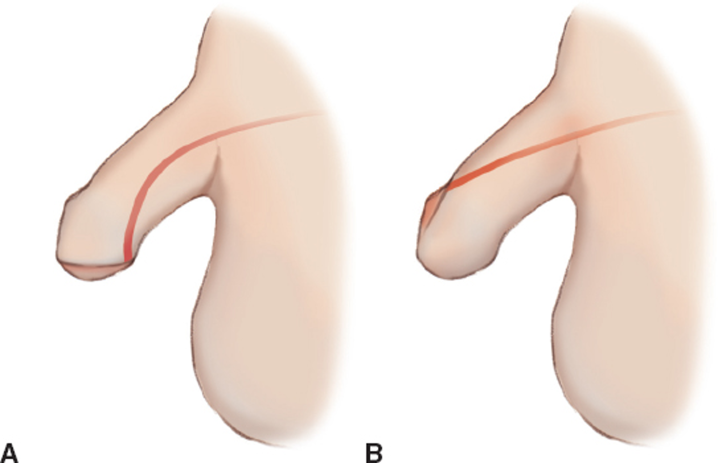 <p>defect in which the opening is on the ventral surface of the penis rather than at the end of the penis; •usually repaired 6 mo. – 1 year</p>