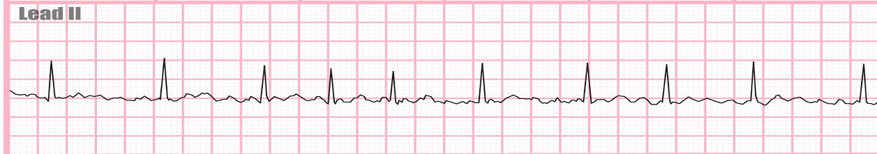 <p>a) premature atrial contraction (PAC)</p><p>b) atrial flutter</p><p>c) atrial fibrillation</p><p>d) torsades de pointes</p><p>e) ventricular fibrillation</p>