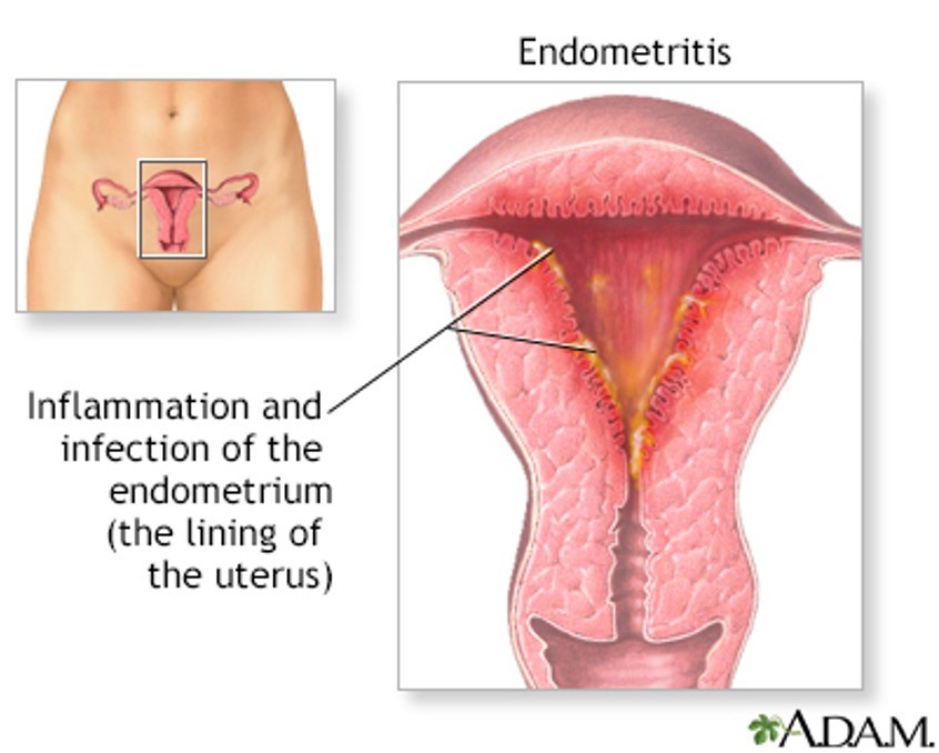 <p>•Most common with labor then c-section</p><p>•Bacteria from the vagina, bowel and perineum invade the uterus</p><p>•S/S start within 1-2 days of delivery; fever, tachycardia, uterine tenderness</p><p>•Antibiotics needed</p>