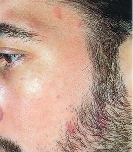 Common vascular cancer in HIV-infected persons.
Considered an AIDS-defining illness, can occur at any stage of HIV
infection. Multiple patch-stage early lesions are faint pink on the temple
and beard area. They easily could be mistaken for bruises or nevi and be
ignored. The use of highly active antiretroviral therapy has decreased the risk
of this cancer.
