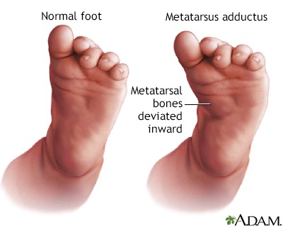 <p>Medal deviation of forefoot</p><p>-occurs most commonly in utero</p><p>-observation</p><p>-stretching</p><p>-serial casting</p><p>surgery-rarely</p>