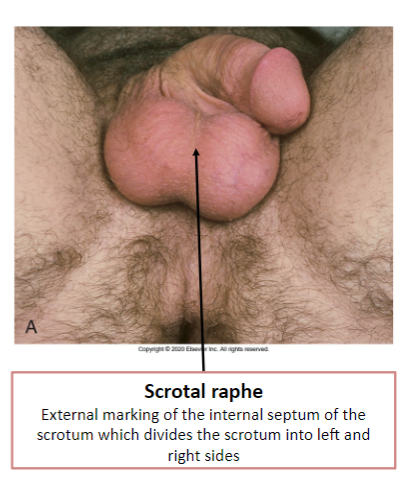 <p>The scrotum contains the left and right testes and the spermatic cord, separated by a septum.</p>