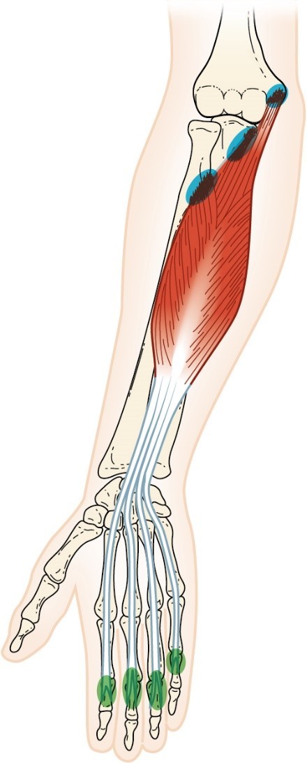 <p>Flexor digitorum superficialis muscle</p>