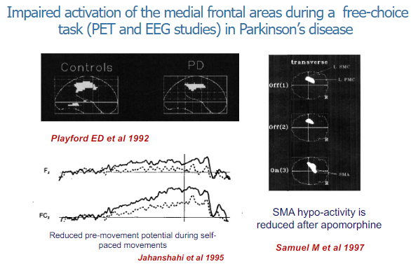 <p>In Parkinson's disease, there is impaired activation of the medial frontal areas during free-choice tasks.</p><p>This has been observed through PET (Positron Emission Tomography) and EEG (Electroencephalogram) studies, indicating difficulties in initiating or selecting actions independently.</p>