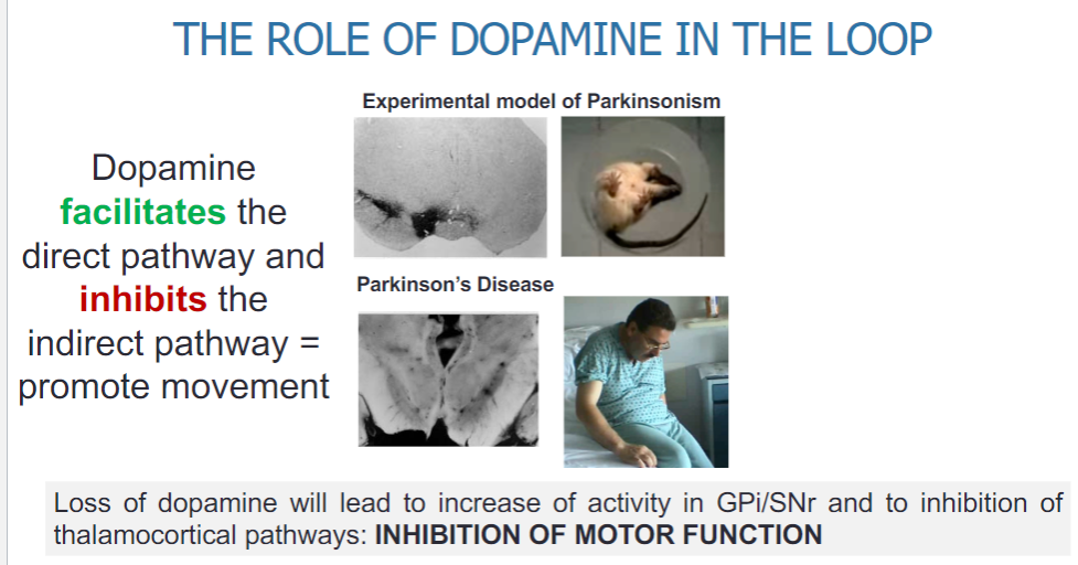 <p>The loss of dopamine leads to increased activity in the GPi/SNr.</p><p>This increased activity results in the inhibition of thalamocortical pathways.</p><p>The outcome is a reduction in motor function, contributing to the symptoms of Parkinson's disease.</p>