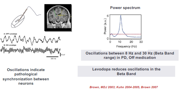 <p>The "Oscillation Model" suggests that the basal ganglia function through synchronized oscillatory activity, which plays a critical role in motor control.</p><p>LFP recordings provide insights into how oscillatory activity within the basal ganglia, particularly in the beta band, correlates with motor symptoms in disorders like Parkinson’s disease.</p><p>These recordings have revealed that pathological oscillations, such as excessive beta-band activity, contribute to motor dysfunctions like rigidity and bradykinesia in Parkinson's disease.</p>