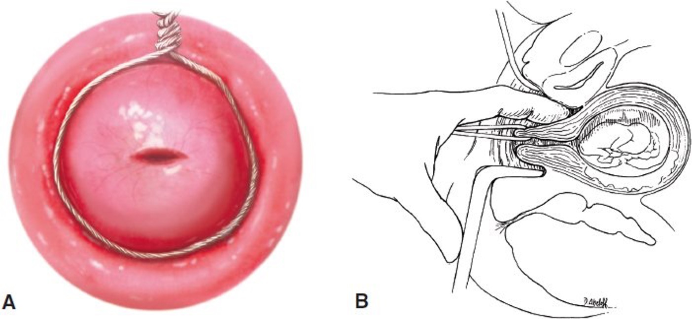 <p><u>Cerclage Procedures</u>:</p><p>-McDonald procedure a purse-string technique is placed high up in the cervix and then tied closed. (12,3,6,9 and tied at 12 o’clock)</p><p>-Shirodkar procedure places a submucosal band at the level of the internal os.</p><p><strong><u>-Abdominal Cerclage:</u></strong> band is placed around cervix through abdomen.</p>