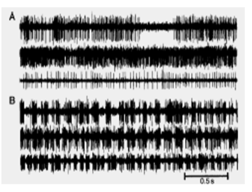 <p>The pattern of basal ganglia output, rather than just its level, plays a crucial role in motor control.</p><p>Bergman (1998) demonstrated that microelectrode recordings from single neurons in the GPi of normal and MPTP-treated monkeys showed different firing patterns, suggesting that the timing and rhythm of activity are important for motor function.</p>