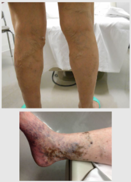 <p>♡ Varicose veins are <strong>swollen and enlarged veins that usually occur on the legs and feet</strong></p><p>♡ They may be blue or dark purple, and are often lumpy, bulging or twisted in appearance</p><p>♡ Other symptoms include: aching, heavy and uncomfortable legs. Swollen feet and ankles</p>