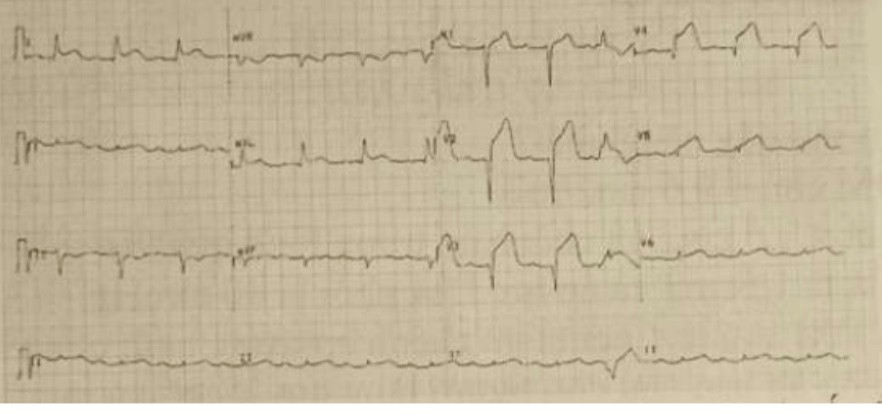 <p>2. Chế độ thuốc chống ngưng tập tiểu cầu cho ngay liều ban đầu (loading dose) phù hợp nhất cho BN trong số các phương án sau là:&nbsp; </p><p>A. Aspirin 300mg + clopidogrel 300 mg&nbsp; </p><p>B. Aspirin 300mg + clopidogrel 600 mg </p><p>C. Aspirin 150mg + clopidogrel 300 mg </p><p>D. Aspirin 300mg + clopidogrel 150 mg</p>