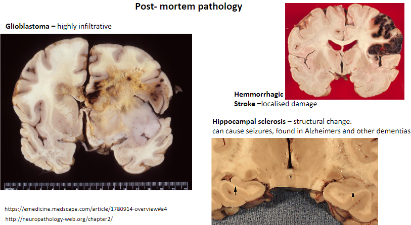 <p>Structural change in the hippocampus.</p><p>Can cause seizures.</p><p>Found in Alzheimer's and other dementias.</p>