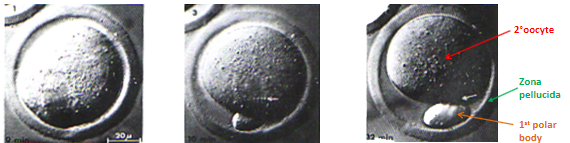 <p><strong>LH surge</strong> triggers the nucleus of the oocyte in the dominant follicle to complete the <strong>first meiotic division</strong>.</p><p>Half of the chromosomes are packaged into the <strong>first polar body</strong>, a small structure within the egg.</p><p>The egg, retaining most of the cytoplasm, becomes a <strong>secondary oocyte</strong>.</p><p>The <strong>first polar body</strong> does not divide further and has no further role in the process.</p><p>The oocyte begins the <strong>second meiotic division</strong> but arrests again.</p>