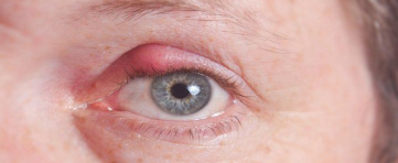 <p>What eye infection is being shown in the picture? </p>