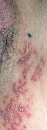 Small, grouped vesicles emerge along route of
cutaneous sensory nerve, then pustules, then
crusts. Caused by the varicella zoster virus (VZV),
a reactivation of the dormant virus of chickenpox.
Acute appearance, unilateral, does not cross
midline. Commonly on trunk; can be anywhere. If
on ophthalmic branch of cranial nerve V, it poses
risk to eye. Most common in adults older than 50
years. Pain is often severe and long-lasting in aging
adults, called postherpetic neuralgia.
