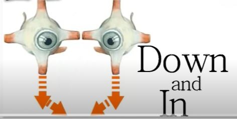 <p><strong>trochlear</strong></p><p>Motor</p><p>Superior oblique eye muscle</p><p>damage:strabismus(eye not parallel), diplopia double vision</p>