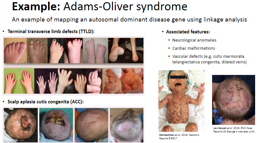 <p><strong>Adams-Oliver syndrome</strong> involves <strong>autosomal dominant inheritance</strong>.</p><p><strong>Terminal transverse limb defects</strong> (TTLD) and <strong>scalp aplasia cutis congenita</strong> (ACC) are characteristic features.</p><p>Associated features include:</p><p><strong>Neurological anomalies</strong></p><p><strong>Cardiac malformations</strong></p><p><strong>Vascular defects</strong> (e.g., <strong>cutis marmorata telangiectatica congenita</strong>, <strong>dilated veins</strong>)</p>