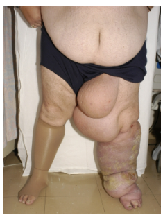 <p>Chronic oedema caused by a developmental abnormality or dysfunction of the lymphatic system.</p><p>Often progressive, with phenotypes varying by <strong>age of onset</strong>, <strong>site</strong>, <strong>inheritance patterns</strong>, <strong>associated features</strong>, and <strong>genetic causes</strong>.</p><p>Leads to debilitating, embarrassing, and stressful symptoms with recurrent infections.</p>