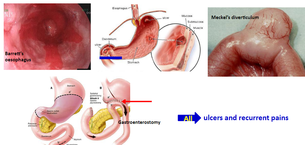 <p>♪Gastric acid secretion disorders affect the gastrointestinal (GIT) function, which includes storage, secretion, digestion, absorption of nutrients, salts, water, metabolism, and elimination of (undigested) wastes.</p><p>♪Malformation of the GIT can lead to a decrease in the nutrient status of the individual.</p><p>♪Peptic ulcers affect approximately 10% of the population and can occur in various sites such as the esophagus, stomach, and duodenum.</p><p>♪Peptic ulcer formation involves the breakage of the mucosal barrier and an imbalance between protective and damaging factors of the GIT.</p><p>♪Tissues are exposed to the erosive effects of gastric acids (HCl), bile acids, and pepsin due to this imbalance, leading to ulceration.</p>