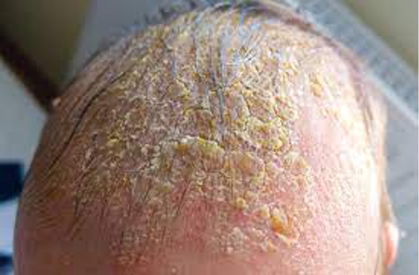 <p>-<strong>Seborrhea-chronic inflammatory dermatitis</strong> that may occur on the skin or scalp; excess oil accumulation; <strong>cradle cap</strong>.</p><p>-<strong>Psoriasis</strong>-chronic inflammatory skin disease with periods of remission and exacerbation; build up of scaley red lesions that&nbsp;may burn or itch</p>