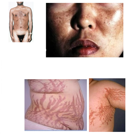 <p><strong>Cushing's syndrome</strong>: A condition caused by excess cortisol secretion.</p><p><strong>Exogenous Cushing's syndrome</strong>: Caused by taking cortisol-like medications (e.g., prednisone) for treating inflammatory disorders, asthma, rheumatoid arthritis, or after organ transplants.</p><p><strong>Endogenous Cushing's syndrome (Cushing's disease)</strong>: Occurs when a pituitary tumor produces too much ACTH, leading to excess cortisol production.</p>