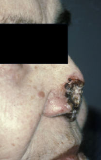 <p><strong>Basal cell carcinoma (BCC)</strong>, also known as <strong>‘rodent ulcer’</strong>, is a type of <strong>non-melanoma skin cancer</strong> often caused by <strong>UV irradiation</strong>.</p><p>It is <strong>often curable by surgery</strong>, particularly if <strong>reported early</strong>.</p>