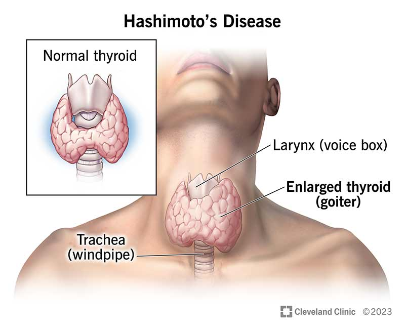 <p>Autoimmune condition, low circulating thyroid hormone (TH), high TSH, lethargy, intolerance to cold, lack of growth and development, and diffuse goitre.</p>