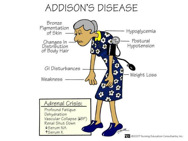 <p>Addison's disease is a condition characterized by primary adrenal insufficiency, which is rare compared to secondary adrenal insufficiency. It involves damage to the adrenal cortex, resulting in significantly decreased hormone production and numerous symptoms.</p>