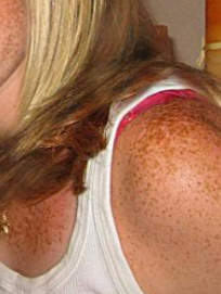 <p><strong>Freckles</strong> (ephelides) have a <strong>genetic component</strong> and are often linked to individuals with <strong>red/fair hair</strong>.</p><p>They are <strong>associated with MC1R gene variants</strong>.</p><p>Freckles typically appear in <strong>sun-exposed areas</strong> of the skin.</p>