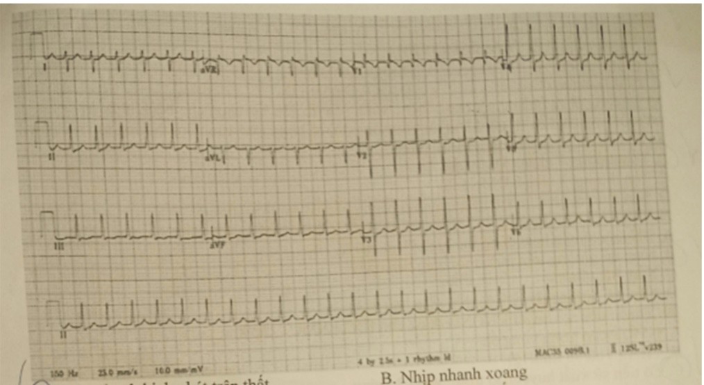 <p>19. BN nữ 36 tuổi vào viện vì hồi hộp trống ngực. Chần đoán điện tâm đồ: </p><p>A.Nhịp nhanh kịch phát trên thát </p><p>B.Nhip nhanh xoang </p><p>C. Nhip nhanh nhĩ </p><p>D. Nhip nhanh thát</p>
