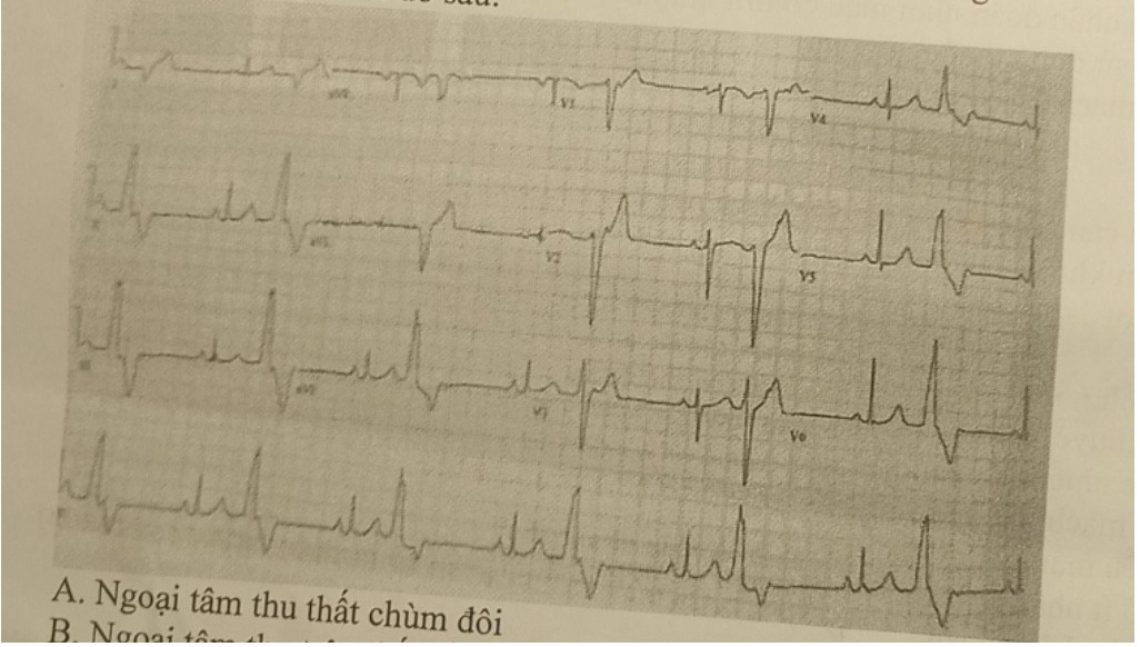 <p>21. Kết quả điện tâm đồ sau: </p><p>A. Ngoại tâm thu thất chùm đôi </p><p>B. Ngoại tâm thu trên thất dẫn truyền lệch hướng </p><p>C. Nhịp nhanh thất </p><p>D. Ngoại tâm thu thất nhịp đôi</p>