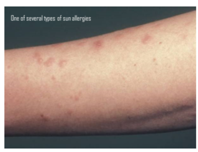 <p><strong>Polymorphic light eruption</strong> is a skin condition triggered by <strong>UV irradiation</strong>.</p><p>It results in a <strong>rash</strong> that appears after sun exposure, particularly in individuals with sensitive skin.</p>