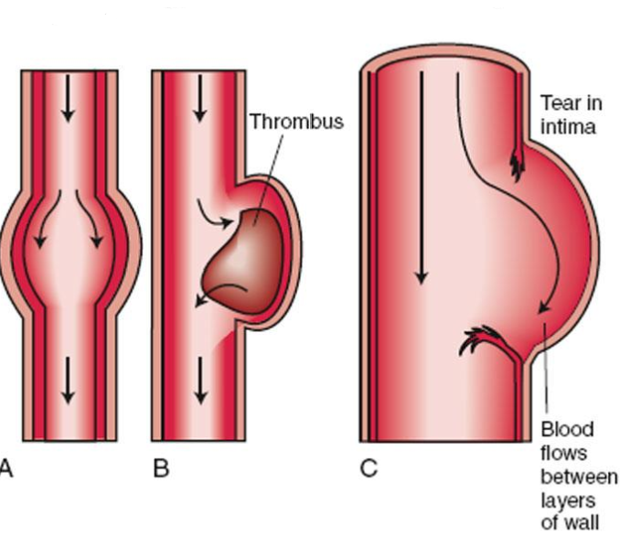 <p>Name the different forms of aortic aneurysm.</p>