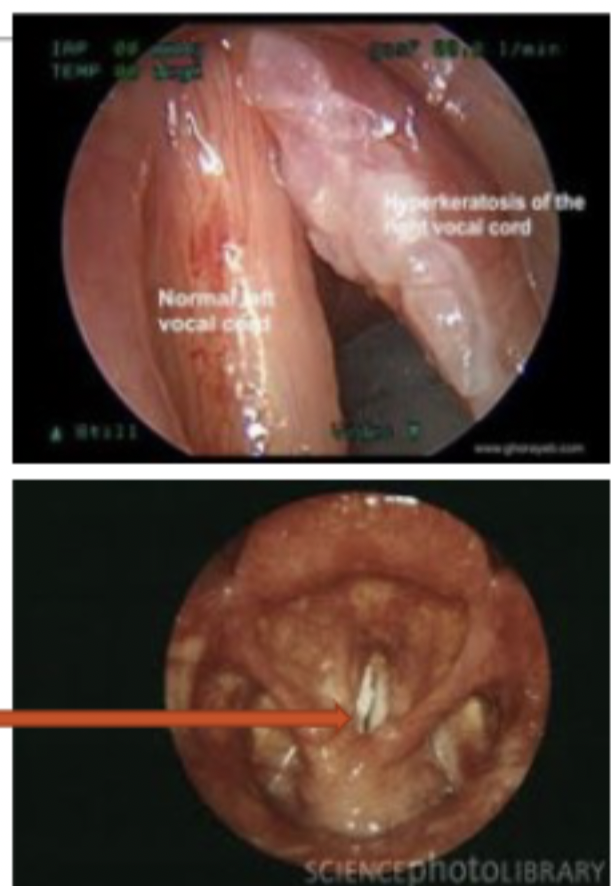 <p>Epthelial lesions in which there is an abnormal tissue growth on the vocal folds. Originates in the epithelium but may extend into the lamina propria. A pathological condition comprised of an accumulation of keratin on the epithelial surface. Two kinds of lesions: ◦ flat, white , plaque-like lesions known as leukoplakia on the laryngeal mucosa◦ Irregular growth of the epithelium resulting in a wart-like lesion known as papillary keratosis.</p>