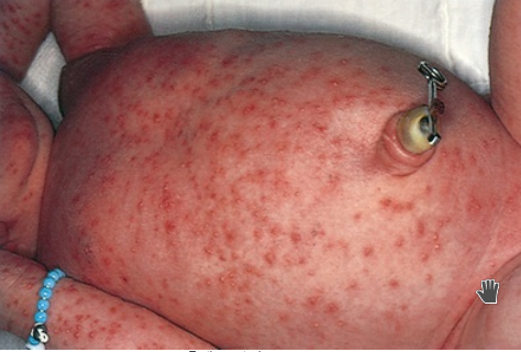 Common rash that appears in the first 3-4 days of life. Sometimes called the "flea bite" rash or newborn rash, consists of tiny punctuate red macules and papules on the cheeks, trunk, chest, back, and buttocks. 

