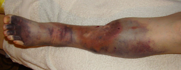 <p>♡ Inflammation along with damage to the venous valves from the thrombus itself</p><p>♡ Valvular incompetence combined with persistent venous obstruction inducing a rupture of small superficial veins, subcutaneous hemorrhage, and an increase of tissue permeability</p><p>♡ Symptoms include pain, swelling, discoloration, and even ulceration</p>